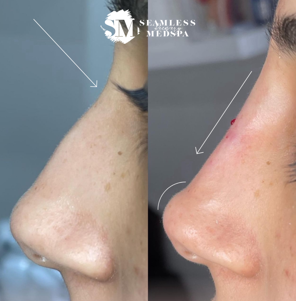 Non Surgical Rhinoplasty Nose Filler